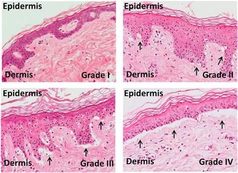 Figure Grades Of Skin Graft Versus Host Disease Statpearls