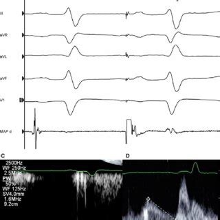 Electrocardiogram ECG Intra Cardiac Electrogram And Echo