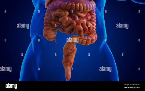 Human Damaged Digestive System For Medical Concept D Illustration