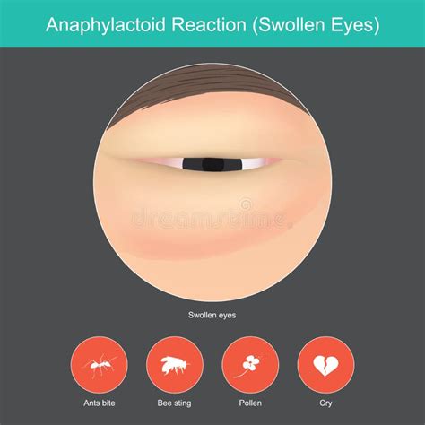 Anaphylactoid Reaction. Illustration Show Close Up. Stock Vector - Illustration of human ...