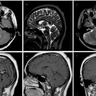 a-f. Brain MRI lesions of the first case. Axial FLAIR (a), Sagittal T2 ...