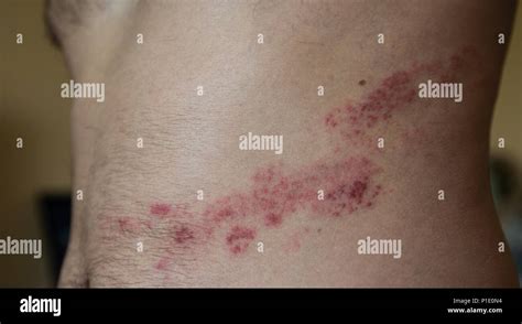 Herpes zoster Fotos und Bildmaterial in hoher Auflösung Alamy