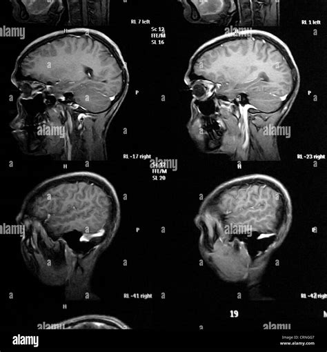 X Ray Of Patient With Brain Cancer Stock Photo Alamy