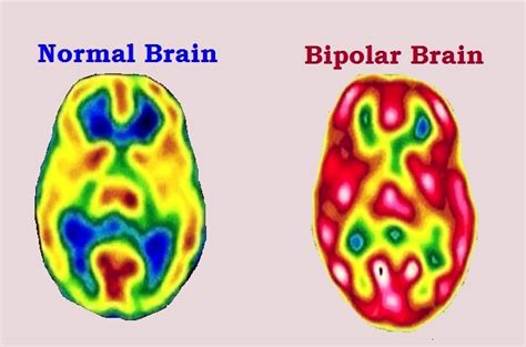 High Functioning Bipolar Disorder Symptoms Causes And More