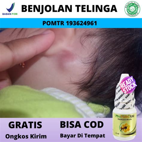 Obat Benjolan Di Telinga Anak Bayi Untuk Benjolan Di Belakang Telinga