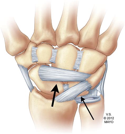 MRI Of Wrist Ligaments Journal Of Hand Surgery