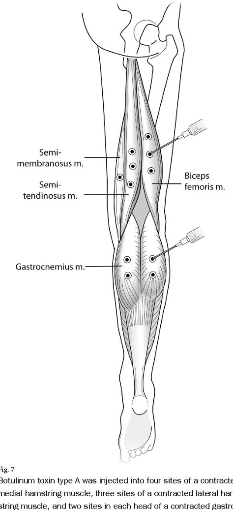 Figure From Functional Problems And Arthrofibrosis Following Total