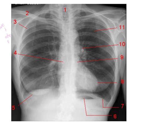 Pa Chest Plain Radiography Diagram Quizlet