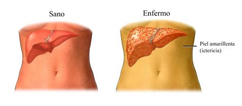 C Ncer De H Gado S Ntomas Y Causas Tumor Benigno Maligno