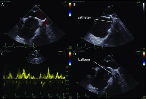 Color Doppler A Records Blood Flow In Red Before The Balloon