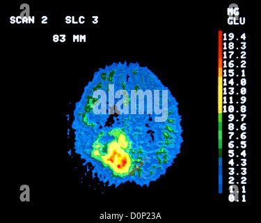 PET Scan Of Brain Tumor Stock Photo Alamy