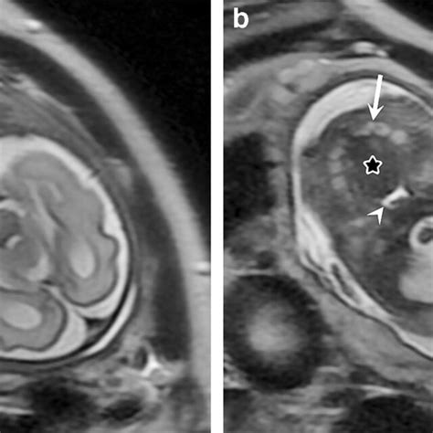 Normal T2 W Axial Airway Images In A 31 Week Fetus A Axial T2 W MR