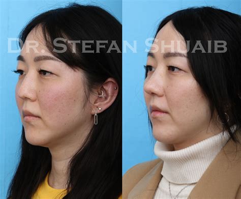 Asian Rhinoplasty Before And After