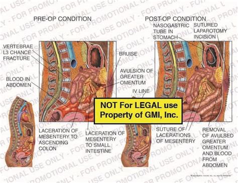 Pre Op Condition Vs Post Op Condition 00022a54a Generic Medical Legal Exhibits A Division Of Mvi