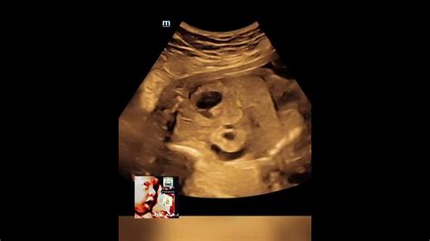 Bilateral Fetal Urinoma Ultrasound By Dr Haissam Aref Dms Msc Md Ultrasound Youtube