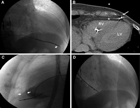 Fluoroscopy Right Anterior Oblique View Showed Displacement Of The