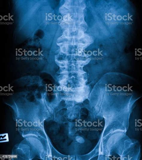 Xray Image Of Plain Kub Supine Position Stock Photo Download Image