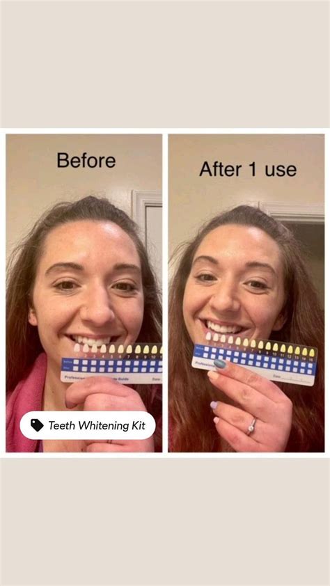 Teeth whitening kit Results before and after/ teeth whitening kit ...