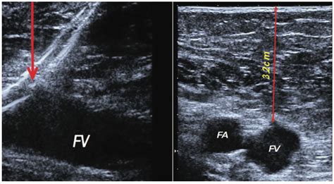 Ultrasound Guided Vascular Access Routes An Overview