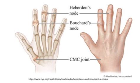 MSK Lower Extremity Disorders Flashcards Quizlet