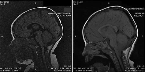 Figure 2 from Unexpected Progression of Tonsillar Herniation in Two ...