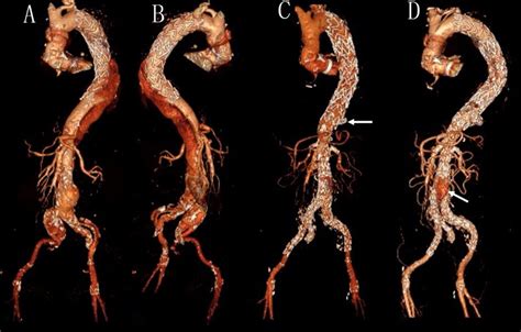 Ct Volume Rendering Reconstruction Of Post Dissection Thoraco Abdominal