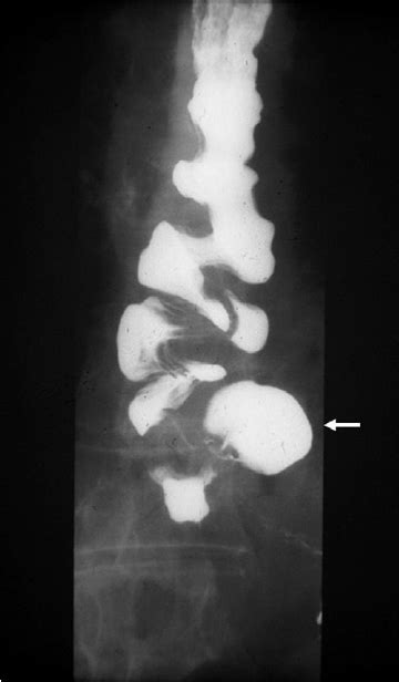 Anteroposterior View From Barium Esophagogram Demonstrat Ing Diffuse