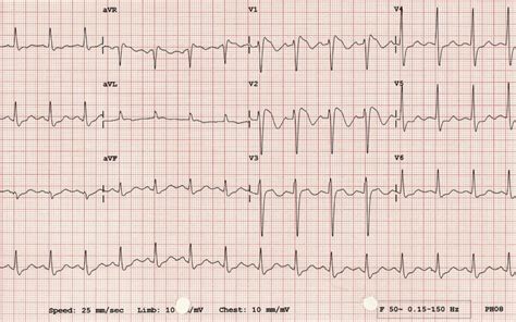 Brugada-type-1 - Medical Exam Prep