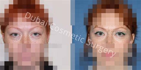 Eyelid Surgery In Dubai Blepharoplasty