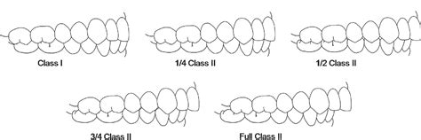 Figure 2 From Class Ii Malocclusion Occlusal Severity Description Semantic Scholar