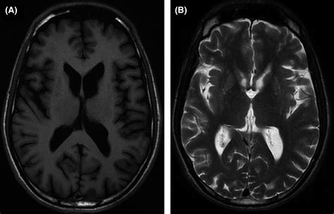 View 23: Huntington's Disease Brain Atrophy | PENULIS | PENULIS ARTIKEL ...