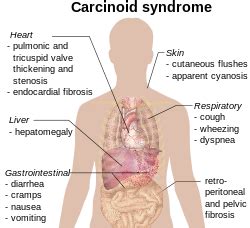 S Ndrome Carcinoide Academialab