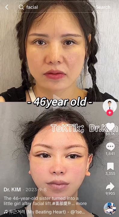 Tiktok Doctor Posts Before And After Pics With Horrifying Results