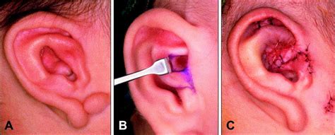 A Rare Case Of Microtia With Hyperplastic Antihelix Journal Of