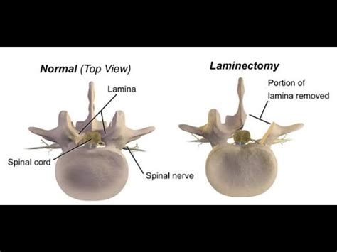 Foraminotomy CPT Code Simplify Medical Coding YouTube