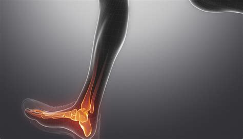 Heel Bursitis Symptoms | Arthritis-health