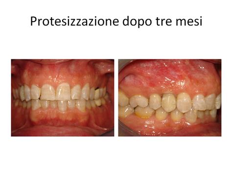 Frattura Di Premolare Dentista Roma