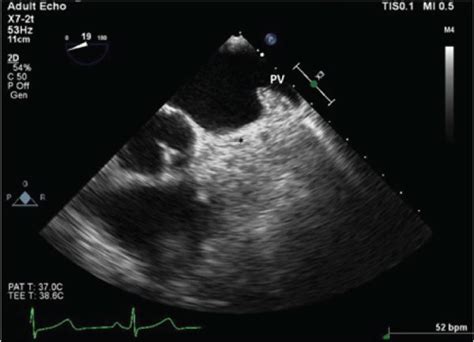 Transesophageal Echocardiogram Tee At Aortic Valve Level Degree