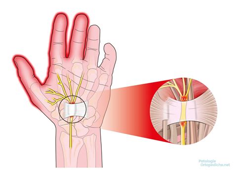 Sindrome del Tunnel Carpale cosè e come si cura