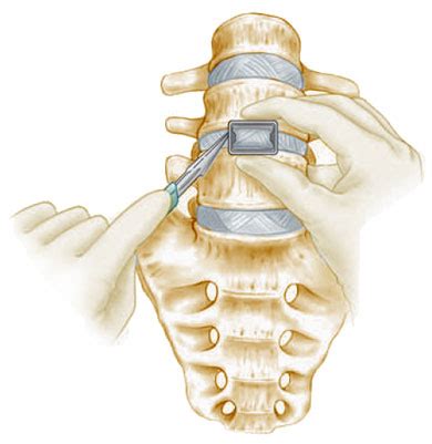 ALIF: Anterior Lumbar Interbody Fusion – Carolina Neurosurgery ...