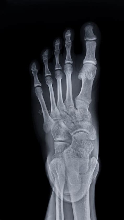 Foot X Ray Image Ap View Isolated On Black Background Stock Image