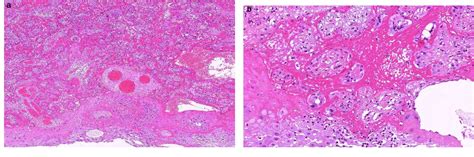 Figure From Pathology Of The Placenta Case Massive Perivillous