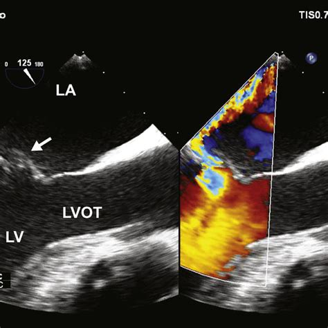 TEE Midesophageal Long Axis View With Color Compare In The Left Hand