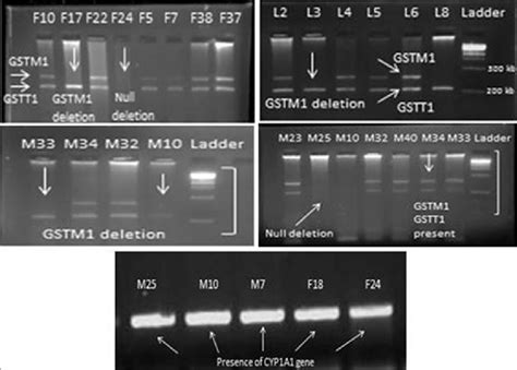 Agarose Gel Showing Deletion Of Gstm And Gstt Genes And The