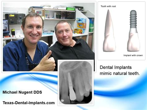 Suffering From Missing Teeth Pasadena Tx Implant Dentist