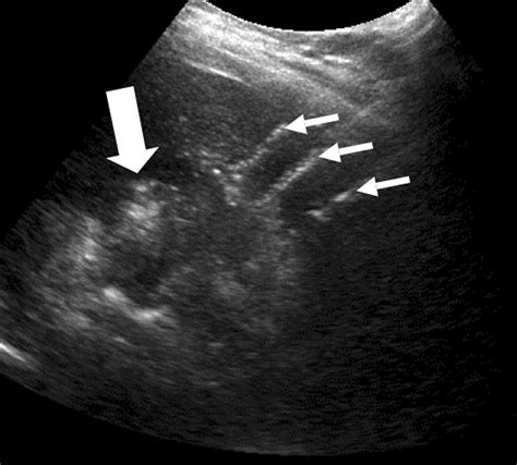 Multiple Electrode Radiofrequency Ablation Of Hepatic Malignancies