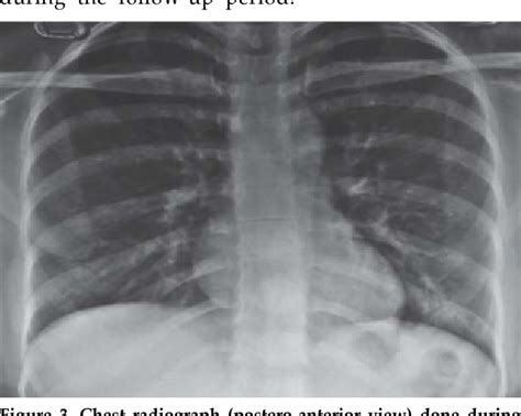 Figure From Symptomatic Unilateral Pleural Effusion Secondary Due To