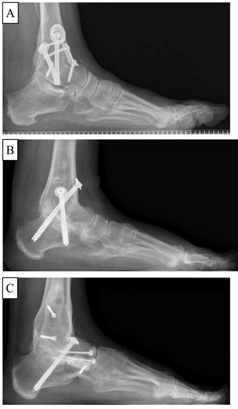 Fused Ankle Bones