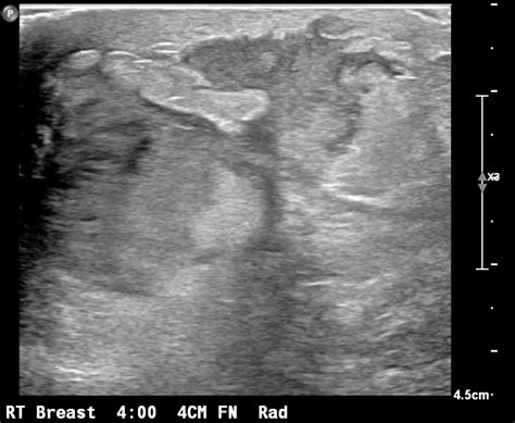 Acute Mastitis