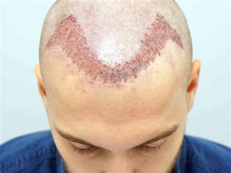 El Trasplante Capilar Y Sus Fases TODO SOBRE ALOPECIA